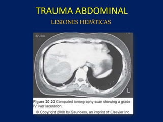 TRAUMA ABDOMINAL
LESIONES HEPÁTICAS
 
