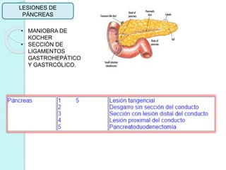 LESIONES DE
PÁNCREAS
• MANIOBRA DE
KOCHER
• SECCIÓN DE
LIGAMENTOS
GASTROHEPÁTICO
Y GASTRCÓLICO.
 