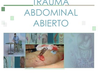 TRAUMA
ABDOMINAL
ABIERTO
 