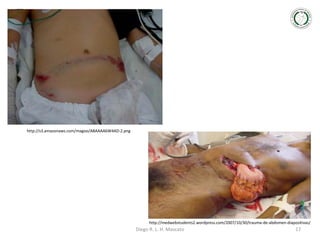 http://s3.amazonaws.com/magoo/ABAAAA6W4AD-2.png

http://medwebstudents2.wordpress.com/2007/10/30/trauma-de-abdomen-diapositivas/

Diego R. L. H. Mascato

17

 