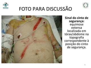 FOTO PARA DISCUSSÃO
Sinal do cinto de
segurança:
equimose
extensa
localizada em
tórax/abdome na
topografia
correspondente à
posição do cinto
de segurança.

75

 