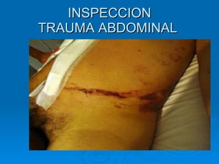 INSPECCION TRAUMA ABDOMINAL  