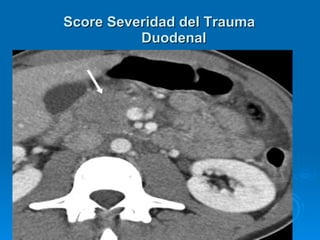 . Score Severidad del Trauma Duodenal 