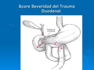 . Score Severidad del Trauma Duodenal 