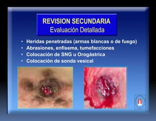 REVISION SECUNDARIA
Evaluación Detallada
• Heridas penetradas (armas blancas o de fuego)
• Abrasiones, enfisema, tumefacciones
• Colocación de SNG u Orogástrica
• Colocación de sonda vesical
 
