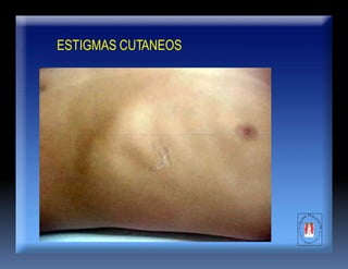 ESTIGMAS CUTANEOS
 
