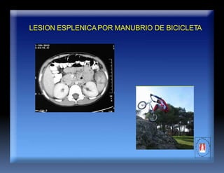 LESION ESPLENICAPOR MANUBRIO DE BICICLETA
 