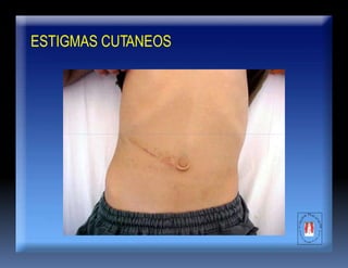 ESTIGMAS CUTANEOS
 