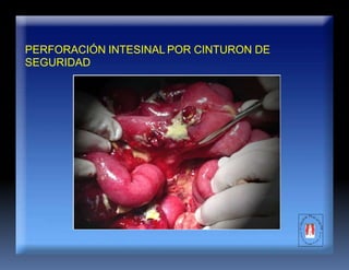 PERFORACIÓN INTESINAL POR CINTURON DE
SEGURIDAD
 