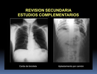 REVISION SECUNDARIA
ESTUDIOS COMPLEMENTARIOS
Caída de bicicleta Aplastamiento por camión
 