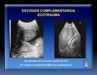 ESTUDIOS COMPLEMENTARIOS
ECOTRAUMA
Sensibilidad para detectar líquido del 91%
Ej: Líquido en espacio de Morrison (perihepático)
 