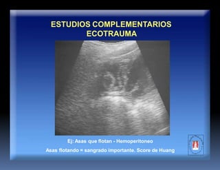 ESTUDIOS COMPLEMENTARIOS
ECOTRAUMA
Ej: Asas que flotan - Hemoperitoneo
Asas flotando = sangrado importante. Score de Huang
 