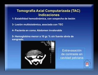 Tomografia Axial Computarizada (TAC)
Indicaciones
1- Estabilidad hemodinámica, con sospecha de lesión
3- Lesión multisistémica, asociada con TEC
4- Paciente en coma. Abdomen invalorable
5- Hemoglobina menor a 10 gr. % sin fuente obvia de
sangrado.
Extravasación
de contraste en
cavidad pelviana
 