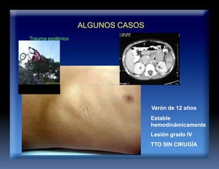 ALGUNOS CASOS
Trauma esplénico
Varón de 12 años
Estable
hemodinámicamente
Lesión grado IV
TTO SIN CIRUGÍA
 