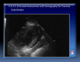 F.A.S.T. (Focused Assessment with Sonography forTrauma)
Subxifoideo
 