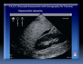 F.A.S.T. (Focused Assessment with Sonography forTrauma)
Hipocondrio derecho
 