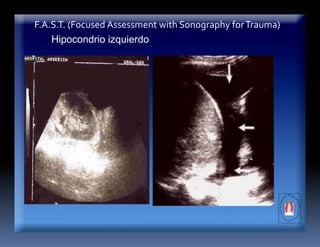 F.A.S.T. (Focused Assessment with Sonography forTrauma)
Hipocondrio izquierdo
 