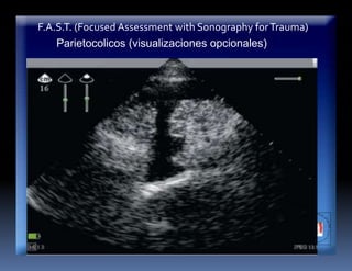 F.A.S.T. (Focused Assessment with Sonography forTrauma)
Parietocolicos (visualizaciones opcionales)
 