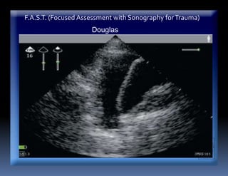 F.A.S.T. (Focused Assessment with Sonography forTrauma)
Douglas
 