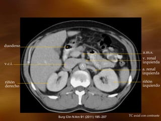 A
TC axial con contraste
duodeno
v.c.i.
riñón
derecho
v. renal
izquierda
a. renal
izquierda
riñón
izquierdo
a.m.s.
 