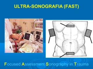 ULTRA-SONOGRAFIA (FAST)
Focused Assessment Sonography in Trauma
 