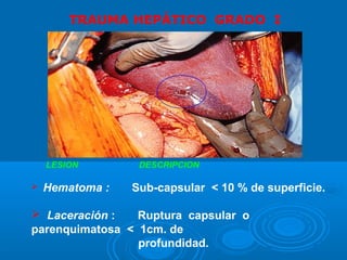 TRAUMA HEPÁTICO GRADO I
LESION DESCRIPCION
 Hematoma : Sub-capsular < 10 % de superficie.
 Laceración : Ruptura capsular o
parenquimatosa < 1cm. de
profundidad.
 