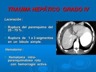 TRAUMA HEPÁTICO GRADO IVTRAUMA HEPÁTICO GRADO IV
LaceraciónLaceración ::
 Ruptura del parenquima delRuptura del parenquima del
25 - 75 % .25 - 75 % .
 Ruptura de 1 a 3 segmentosRuptura de 1 a 3 segmentos
en un lóbulo simple.en un lóbulo simple.
Hematoma :Hematoma :
 Hematoma intra-Hematoma intra-
parenquimatoso rotoparenquimatoso roto
con hemorragia activa.con hemorragia activa.
 