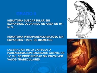 HEMATOMA SUBCAPSULAR SINHEMATOMA SUBCAPSULAR SIN
EXPANSION, OCUPANDO UN AREA DE 10 –EXPANSION, OCUPANDO UN AREA DE 10 –
50 %50 %
HEMATOMA INTRAPARENQUIMATOSO SINHEMATOMA INTRAPARENQUIMATOSO SIN
EXPANSION < 2Cm DE DIAMETROEXPANSION < 2Cm DE DIAMETRO
LACERACION DE LA CAPSULA OLACERACION DE LA CAPSULA O
PARENQUIMACON SANGRADO ACTIVO, DEPARENQUIMACON SANGRADO ACTIVO, DE
1-3 Cm DE PROFUNDIDAD SIN ENVOLVER1-3 Cm DE PROFUNDIDAD SIN ENVOLVER
VASOS TRABECULARESVASOS TRABECULARES
GRADO II
 