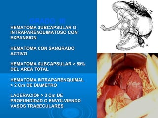 HEMATOMA SUBCAPSULAR OHEMATOMA SUBCAPSULAR O
INTRAPARENQUIMATOSO CONINTRAPARENQUIMATOSO CON
EXPANSIONEXPANSION
HEMATOMA CON SANGRADOHEMATOMA CON SANGRADO
ACTIVOACTIVO
HEMATOMA SUBCAPSULAR > 50%HEMATOMA SUBCAPSULAR > 50%
DEL AREA TOTALDEL AREA TOTAL
HEMATOMA INTRAPARENQUIMALHEMATOMA INTRAPARENQUIMAL
> 2 Cm DE DIAMETRO> 2 Cm DE DIAMETRO
LACERACION > 3 Cm DELACERACION > 3 Cm DE
PROFUNDIDAD O ENVOLVIENDOPROFUNDIDAD O ENVOLVIENDO
VASOS TRABECULARESVASOS TRABECULARES
GRADO III
 