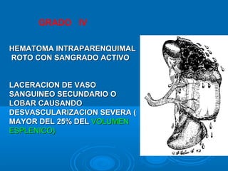 HEMATOMA INTRAPARENQUIMALHEMATOMA INTRAPARENQUIMAL
ROTO CON SANGRADO ACTIVOROTO CON SANGRADO ACTIVO
LACERACION DE VASOLACERACION DE VASO
SANGUINEO SECUNDARIO OSANGUINEO SECUNDARIO O
LOBAR CAUSANDOLOBAR CAUSANDO
DESVASCULARIZACION SEVERA (DESVASCULARIZACION SEVERA (
MAYOR DEL 25% DELMAYOR DEL 25% DEL VOLUMENVOLUMEN
ESPLENICO)ESPLENICO)
GRADO IV
 