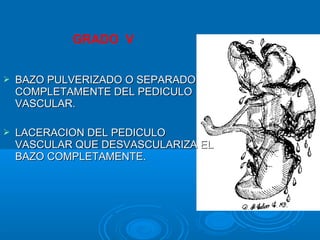GRADO V
 BAZO PULVERIZADO O SEPARADOBAZO PULVERIZADO O SEPARADO
COMPLETAMENTE DEL PEDICULOCOMPLETAMENTE DEL PEDICULO
VASCULAR.VASCULAR.
 LACERACION DEL PEDICULOLACERACION DEL PEDICULO
VASCULAR QUE DESVASCULARIZA ELVASCULAR QUE DESVASCULARIZA EL
BAZO COMPLETAMENTE.BAZO COMPLETAMENTE.
 