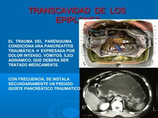 TRANSCAVIDAD DE LOSTRANSCAVIDAD DE LOS
EPIPLONESEPIPLONES
EL TRAUMA DEL PARÉNQUIMA
CONDICIONA UNA PANCREATITIS
TRAUMÁTICA  EXPRESADA POR
DOLOR INTENSO, VÓMITOS, ÍLEO
ADINÁMICO, QUE DEBERA SER
TRATADO MÉDICAMENTE.
CON FRECUENCIA, SE INSTALA
SECUNDARIAMENTE UN PSEUDO
QUISTE PANCREÁTICO TRAUMATICO
 