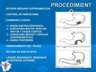 PROCEDIMIENTPROCEDIMIENT
OO
INCISION MEDIANA SUPRAUMBILICAL
CONTROL DE HEMOSTASIA
EXAMINAR 4 ZONAS:
1.- UNION GASTRO-ESOFAGICA
2.- CURVATURA MAYOR, EPIPLON
MAYOR Y VASOS CORTOS
3.- CURVATURA MENOR Y EPIPLON
GASTROHEPATICO
4.- PARED POSTERIOR
DEBRIDAMIENTO DEL TEJIDO
SUTURA EN DOS PLANOS
LAVADO ABUNDANTE: REMOSION
DE MATERIAL EXTRAÑO
 