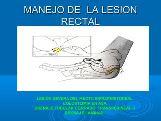 MANEJO DE LA LESIONMANEJO DE LA LESION
RECTALRECTAL
LESION SEVERA DEL RECTO INFRAPERITONEAL
COLOSTOMIA EN ASA
DRENAJE TUBULAR CERRADO TRANSPERINEAL o
DRENAJE LAMINAR
 