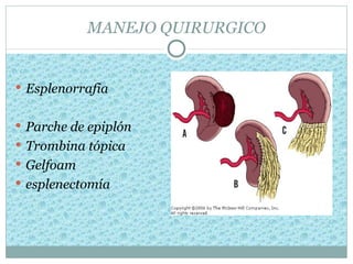 MANEJO QUIRURGICO


 Esplenorrafia


 Parche de epiplón
 Trombina tópica
 Gelfoam
 esplenectomía
 