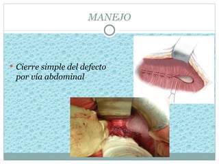 MANEJO



 Cierre simple del defecto
 por vía abdominal
 