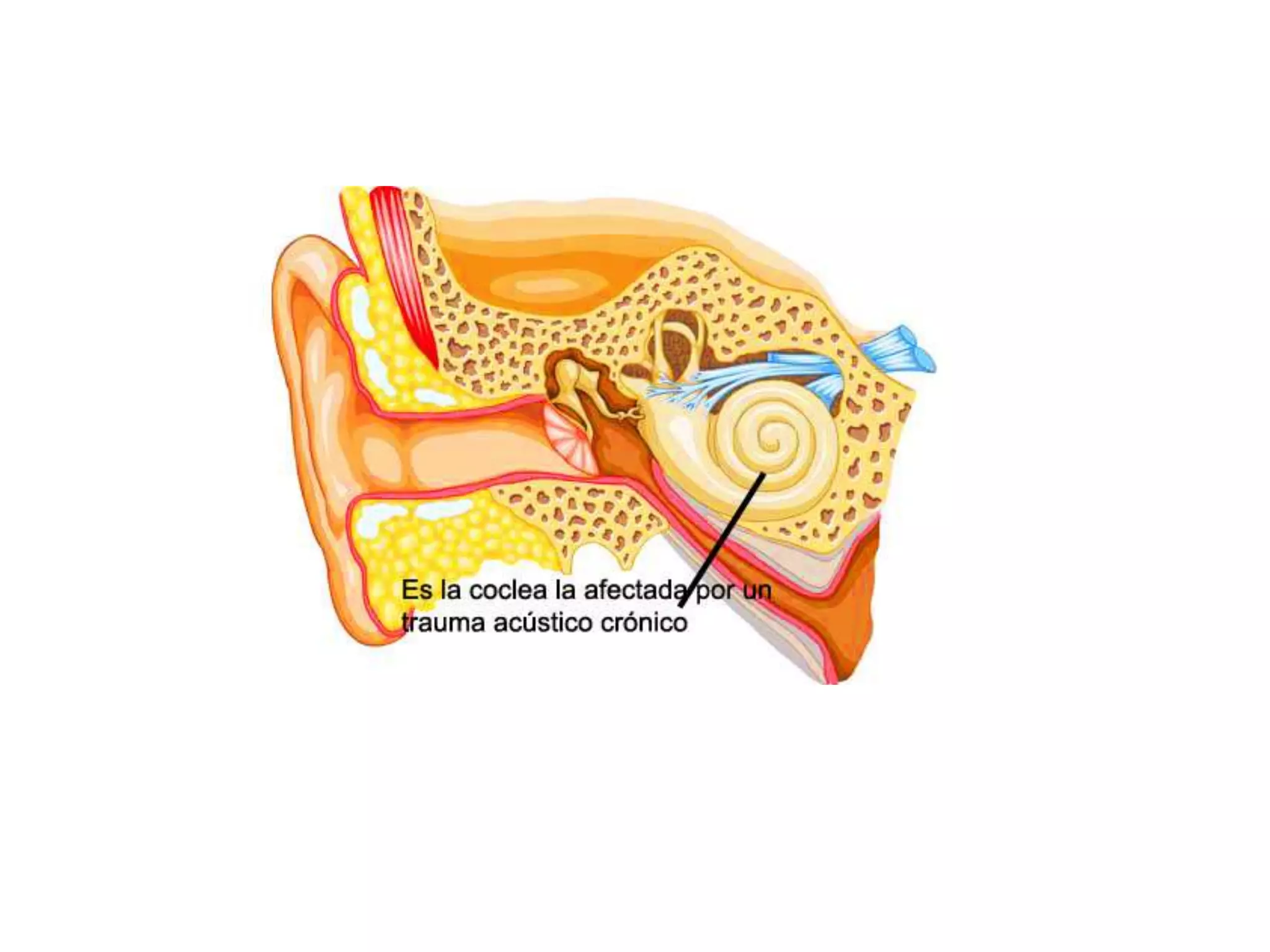 Trauma acústico imagenes