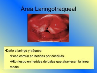 emergentoparucho.com
Área Laringotraqueal
•Daño a laringe y tráquea
•Poco común en heridas por cuchillas
•Alto riesgo en heridas de balas que atraviesan la línea
media
 