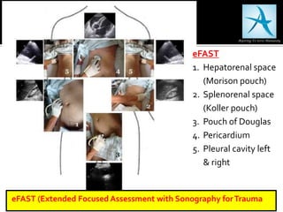 eFAST
1. Hepatorenal space
(Morison pouch)
2. Splenorenal space
(Koller pouch)
3. Pouch of Douglas
4. Pericardium
5. Pleural cavity left
& right
eFAST (Extended Focused Assessment with Sonography forTrauma
 