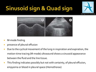 M-mode finding
 presence of pleural effusion
 Due to the cyclical movement of the lung in inspiration and expiration, the
motion-time tracing (M-mode) ultrasound shows a sinusoid appearance
between the fluid and the line tissue.
 This finding indicates possibly but not with certainty, of pleural effusion,
empyema or blood in pleural space (Hemothorax)
 