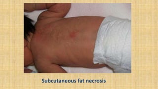 Subcutaneous fat necrosis
 