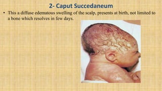 2- Caput Succedaneum
• This a diffuse edematous swelling of the scalp, presents at birth, not limited to
a bone which resolves in few days.
 