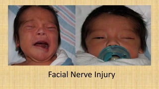. Facial Nerve Injury
 