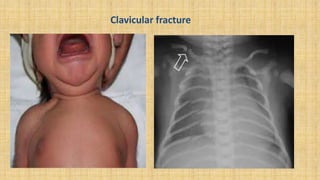 Clavicular fracture
 