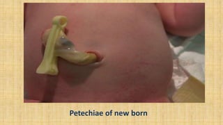 Petechiae of new born
 