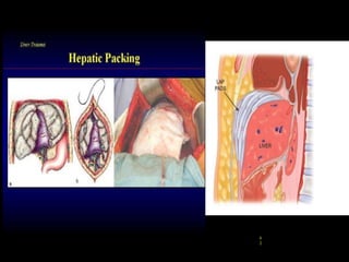 MANAGEMENT OF ABDOMINAL TRAUMA | PPTX