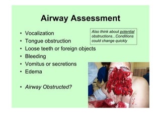 Airway Assessment
                                Also think about potential
•   Vocalization                obstructions...Conditions
•   Tongue obstruction          could change quickly

•   Loose teeth or foreign objects
•   Bleeding
•   Vomitus or secretions
•   Edema

• Airway Obstructed?
 