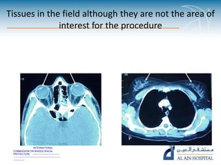 INTERNATIONAL
COMMISSION ON RADIOLOGICAL
PROTECTION ————————————
—————————————————————
—————
Tissues in the field although they are not the area of
interest for the procedure
Lens of the eye Breast tissue
 