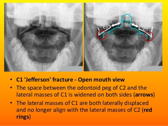 Trauma axial skeleton Dr. Muhammad Bin Zulfiqar