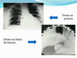 Dente no
pulmão
Dente na linha
de fratura
 